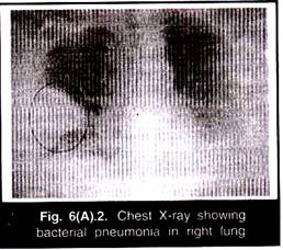 Chest X-ray Showing Bacterial Pneumonia in Right Lung