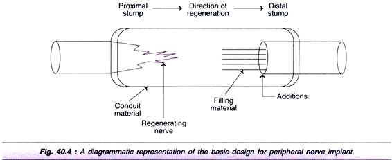 Basic Design for Peripheral Nerve Implant