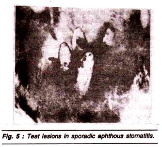 Teat Lesions in Sporadic Aphthous Stomatitis