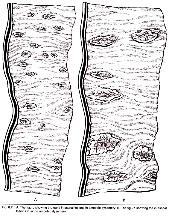 Intestinal Lesions in Amoebic Dysentery and Acute Amoebic Dysentery