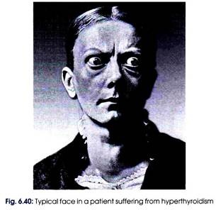 Patient Suffering from Hyperthyroidism