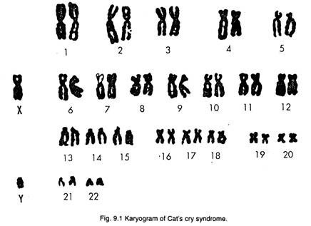 Karyogram of cat's cry syndrome