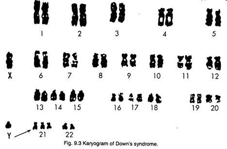 Karyogram of down's syndrome