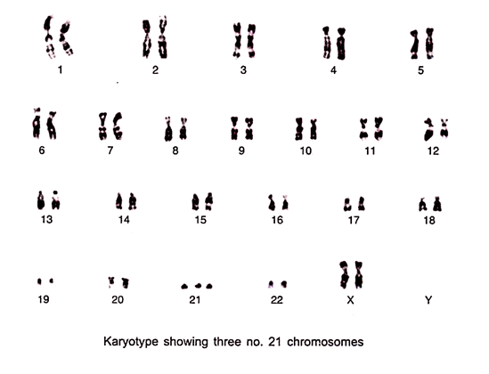 Karyotype showing three no. 21 chromosomes 