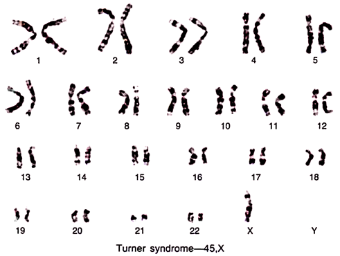 Turner syndrome - 45,X