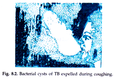 Bacterial Cysts of TB Expelled during Coughing