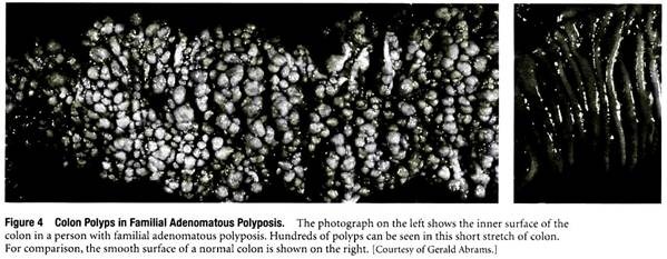 Colon Polyps in Familial Adenomatous Polyposis