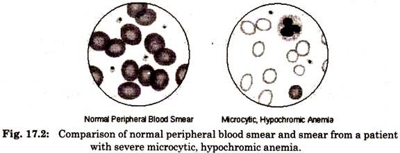 Comparison of Normal Peripheral Blood Smear