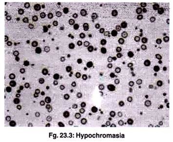 Hypochromasia