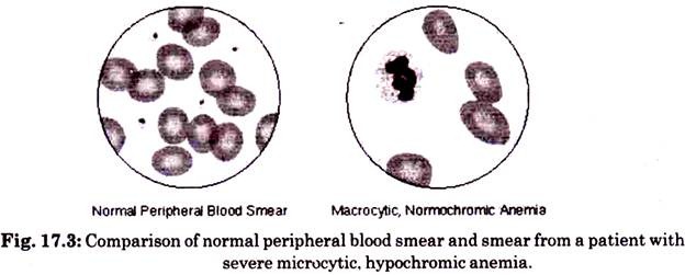 Comparison of Normal Peripheral Blood Smear and Smear