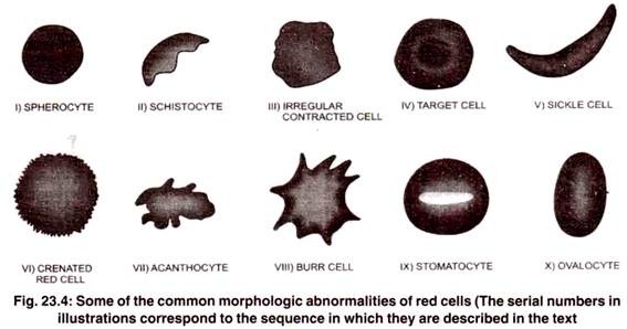 Common Morphologic Abnormalities of Red Cells