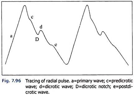 Tracing of Radial Pulse